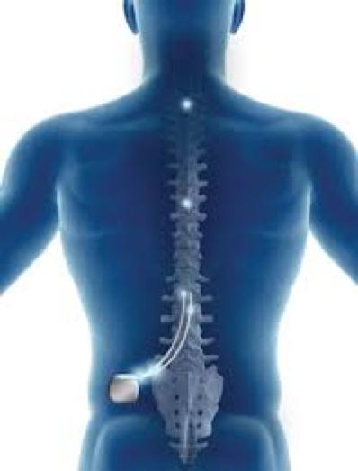 SCS - Spinal Cord Stimulation Ett