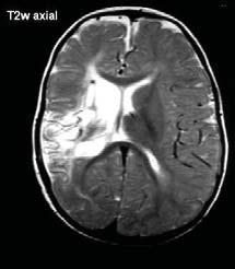 CP spastisk hemiplegi 44% av all CP Handfunktion ofta ett