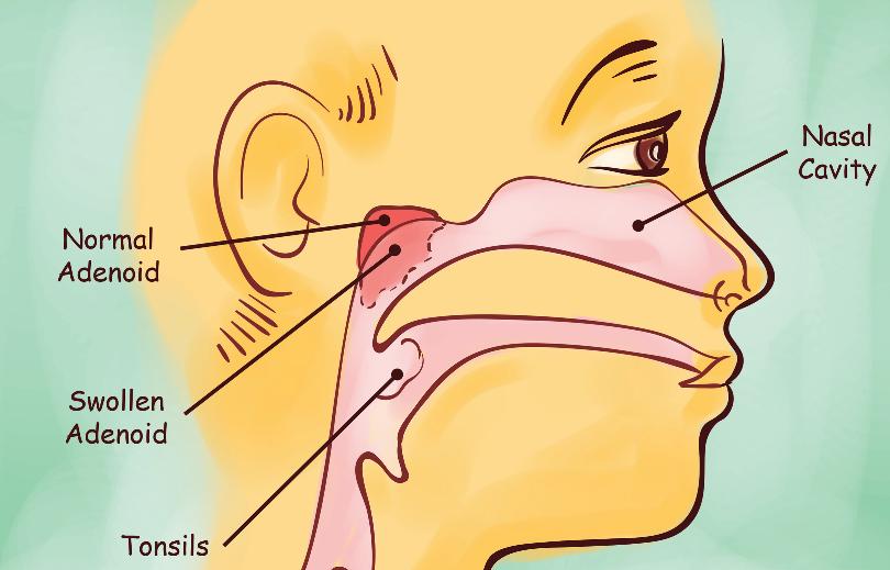 Adenoid Körtel/polyp bakom näsan Ansamling lymfatisk vävnad Minimal vid födsel. Tillväxer t.o.m. 7-8 års ålder.