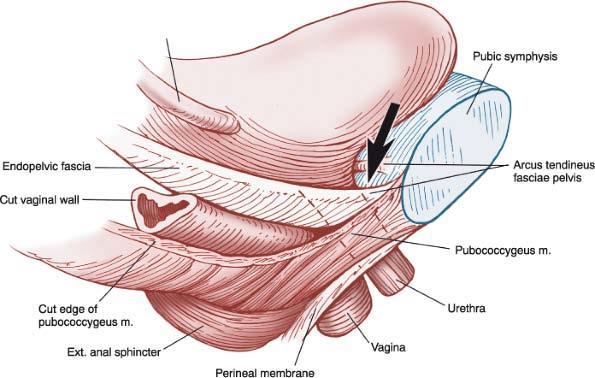 Ansträngninsinkontiens (SUI) Hypermobil urethra Lågt urethra tryck Denervering Ökat buktryck Övervikt Prolaps Ca 40% har också