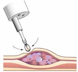 Röntgenledd biopsi, och inte minst kirurgi utan diagnos, är riskfyllda och resurskrävande alternativ.