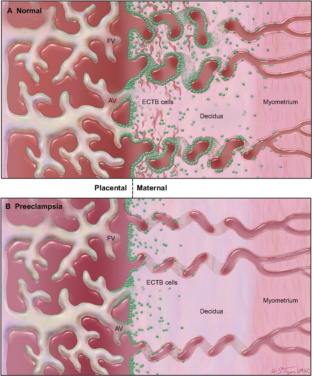 Begränsad trofoblastinvasion i decidua och spiralartärer vid PE och placentainsufficiens Ökad