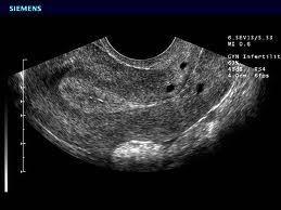 PUL Slutliga diagnoser Intrauterin normal grav PUL med spontan regress i