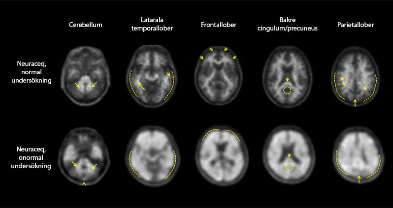 Figur 1: Neuraceq PET-bilder som visar exempel på negativa PET-undersökningar med florbetaben ( 18 F) (överst) och positiva undersökningar (underst).