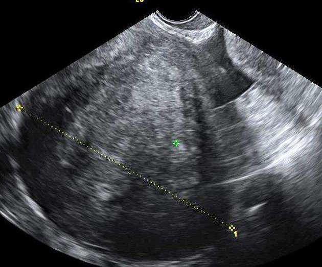 Fibrom fibrotekom tekom Fibrom är den vanligaste benigna könssträngs-stromacellstumören8. Fibrom är inte östrogenproducerande och uppkommer från de kollagen producerade spolcellerna.