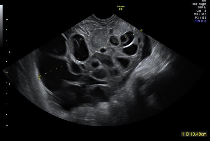 ventrikelcancermetastas