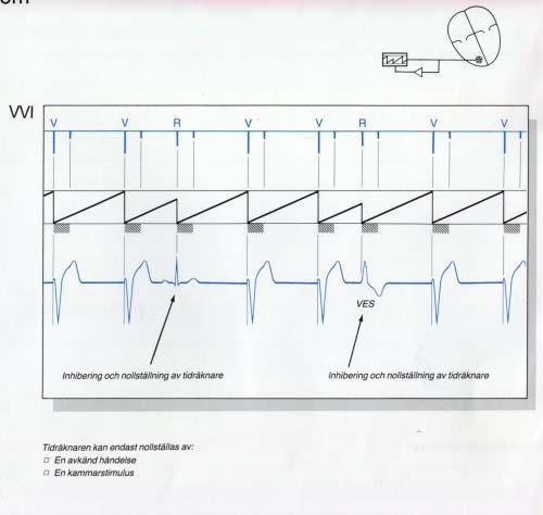 1.4 Pacemakertypologi En pacemakers typ anges med en treställig bokstavskod enligt: Stimulerad kammare (A, V, D) Avkänd kammare (A, V, D) Funktion Exempel: VOO VVI DDD (O=ingen, T=triggad,