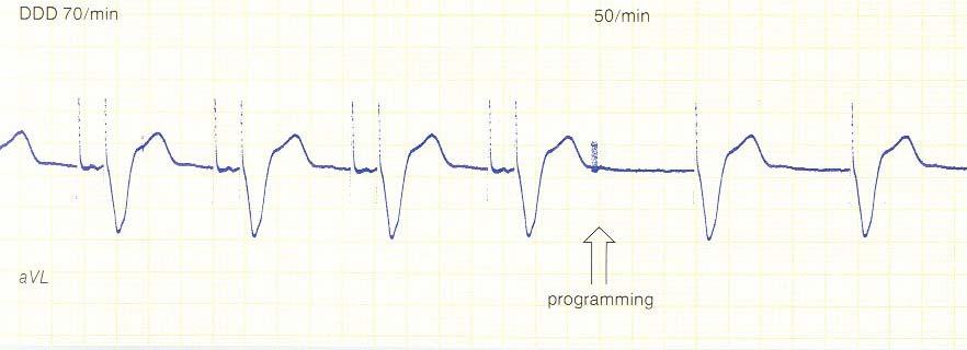 EKG Figur 21