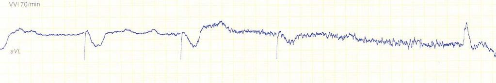 1.8 Pacemakerindikationer AV-block Sjuk sinusknuta Förmaksflimmer