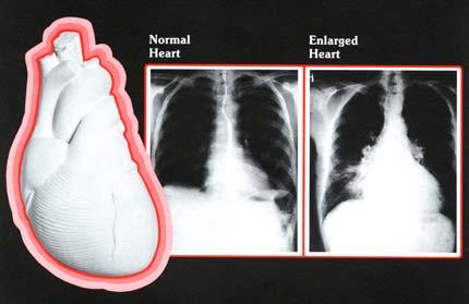 HJÄRTSVIKT The normal patient with HF Elderly person, 70-80 years old, male or female, has had a heart attack,