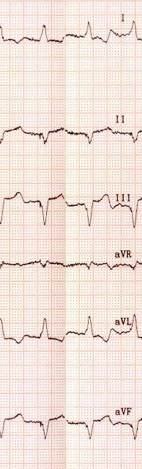 EKG visar QRS-bredd på 150 ms.