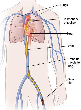 Lungemboli Blodproppen färdas från en ven i benet, via högra hjärthalvan,
