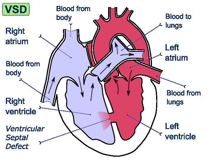 VSD