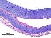 Dissekerande aneurysm Blodet