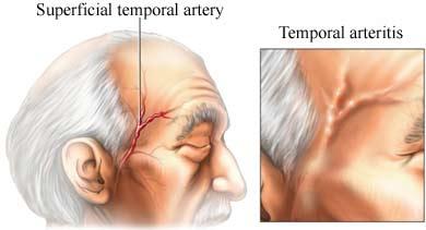 Temporalisarterit Temporalisarterit - Svår smärta över ena tinningen med tuggsmärta.