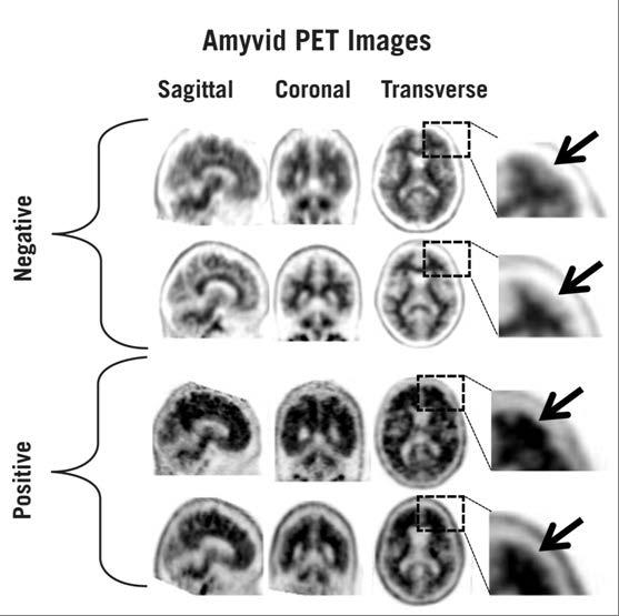Amyvid PET-bilder Sagittal Frontal Transversal Kompletterande användning av kvantitativ information för bildtolkning Endast bildgranskare som har erfarenhet av att använda kvantitativ information som