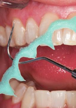 Klinisk steg-för-steg-instruktion från den internationella Ultradent produktkatalogen visar blekningsförfarandet i en över- och en underkäke.