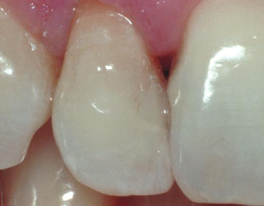BLEKNING PÅ KLINIKEN MED OPALESCENCE ENDO