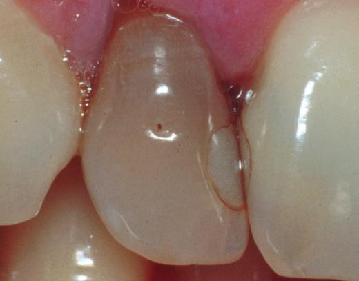 väteperoxid Opalescence Endo är en gel med en
