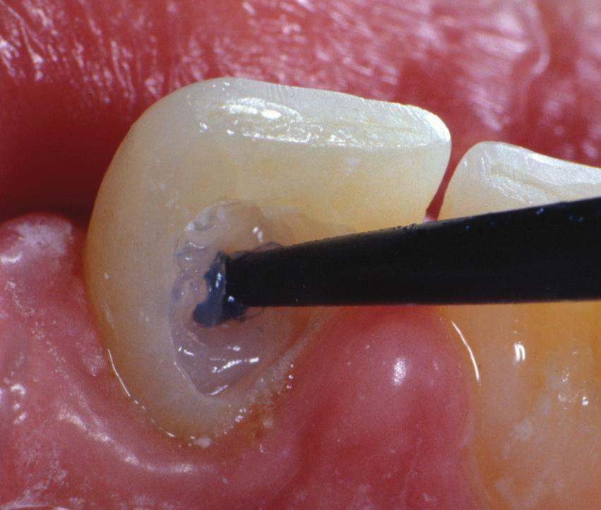 Fråga din dentaldepå.