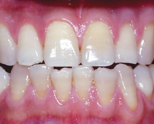 BLEKNING PÅ KLINIKEN MED OPALESCENCE QUICK MEDICINSK BLEKNING MED INDIVIDUELLT ANPASSADE BLEKSKENOR 45 % karbamidperoxid med kaliumnitrat och fluorid Opalescence Quick är en blekgel