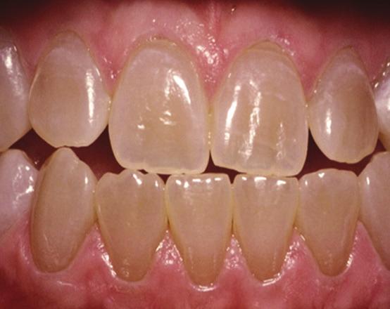 erytroblastos, gulsot och porfyri. Medicintekniska produkter för tandblekning är inte tillgängliga i vissa EU-länder. Fråga din dentaldepå.