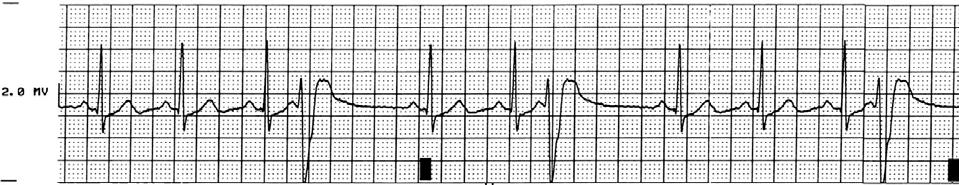 EKG rytmtolkning: Annika Hickisch Fråga 1 En man, Albin, i 60 års ålder kommer in strax innan du avslutar ditt pass. Han klagar över tryck i bröstet. Ni kopplar upp ett övervaknings EKG.