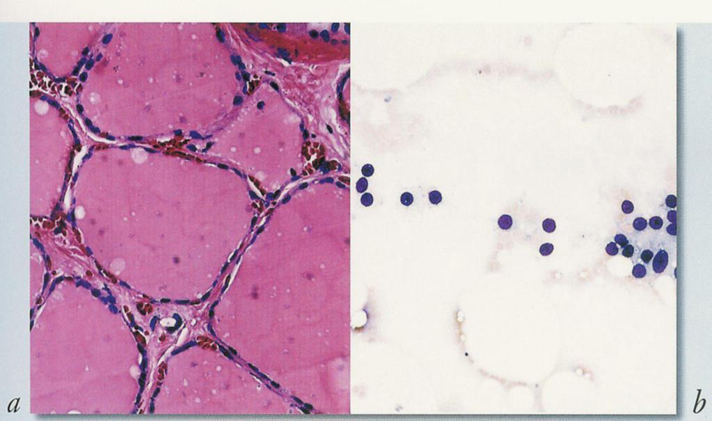 Tyreoidea-cytologi