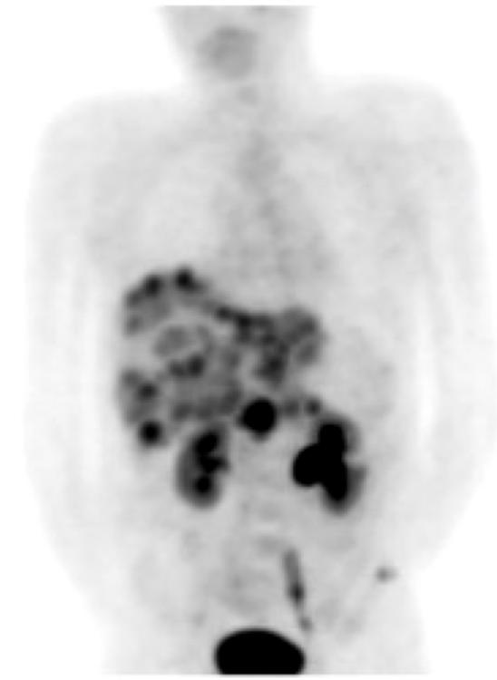 GEP-NET ileum-net (carcinoid) hormonproducerande (serotonin èdiarré, flush) somatostatinreceptorer (SSTR)è lyser