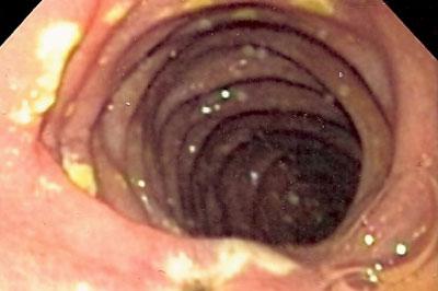 Tumör i pankreas el duodenum (ofta multipla). Oftast maligna.