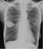 Lungtumörer och differentialdiagnoser 24. Anta att du ser en ganska välavgränsad vit förändring på platsen för fissuren mellan ovanloben och mellanloben på höger sida (se? i bilden nedan).