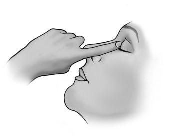 Dra försiktigt ned det nedre ögonlocket, rikta blicken uppåt och tryck ut en droppe i ögat.