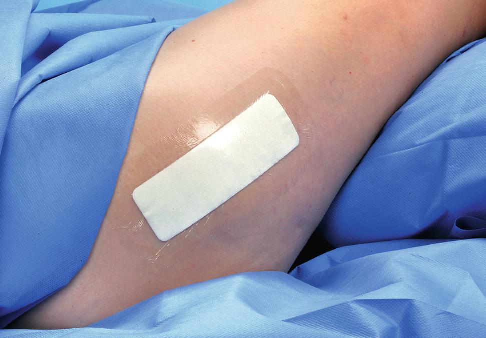 Sårvård Sårvården efter operationen kan påverka uppkomsten av postoperativa sårinfektioner. Om ett sår är kontaminerat är sannolikheten högre för en postoperativ infektion.