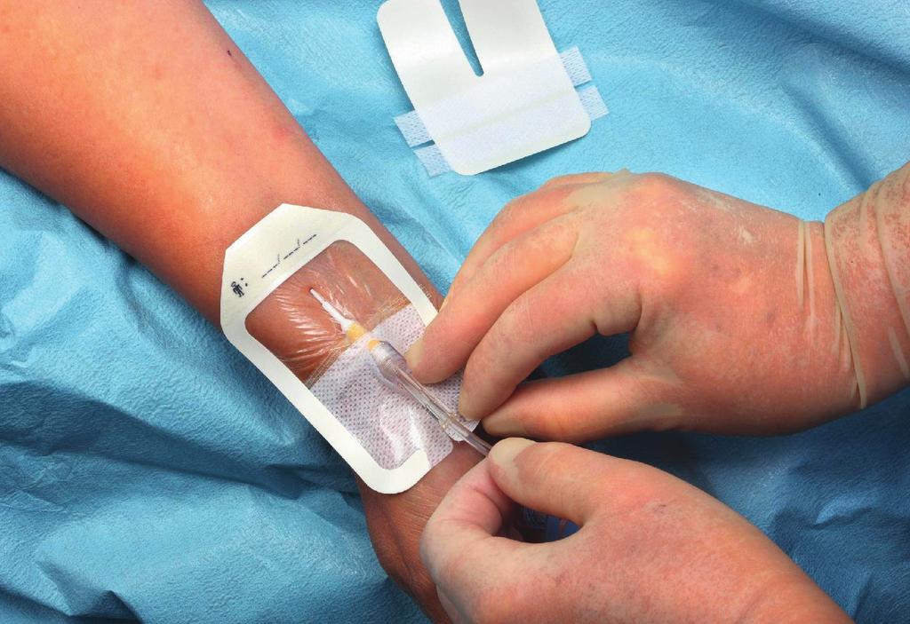Perifera katetrar Evidens CDC: Guidelines for the prevention of intravascular catheter related infections, 2011: http://www.cdc.gov/hicpac/pdf/ guidelines/bsi-guidelines-2011.