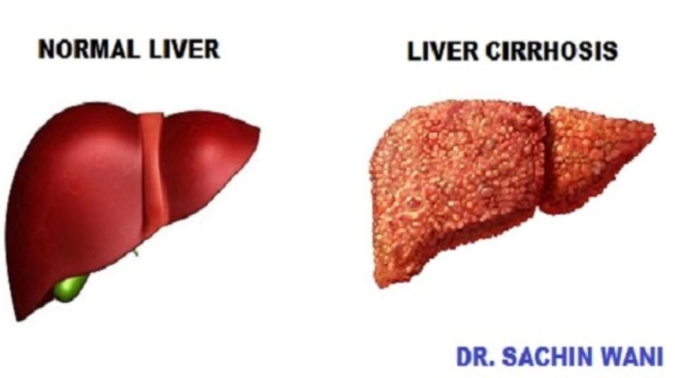 Kvinna 28 år Kronisk leversjukdom och graviditetsutfall 0 gravida Autoimmun hepatit sedan 19 åå Levercirrhos (Imurel, Prednisolon, Inderal) Levercirrhos? Trombocytopeni (trc 60, INR 1.