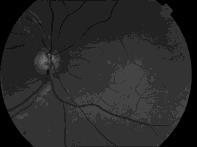 International Clinical Diabetic Retinopathy Disease Serverity Scale Ingen Mild Måttlig Inga synliga