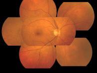 AAO 2015: Early Change in Visual Function in Diabetes: A