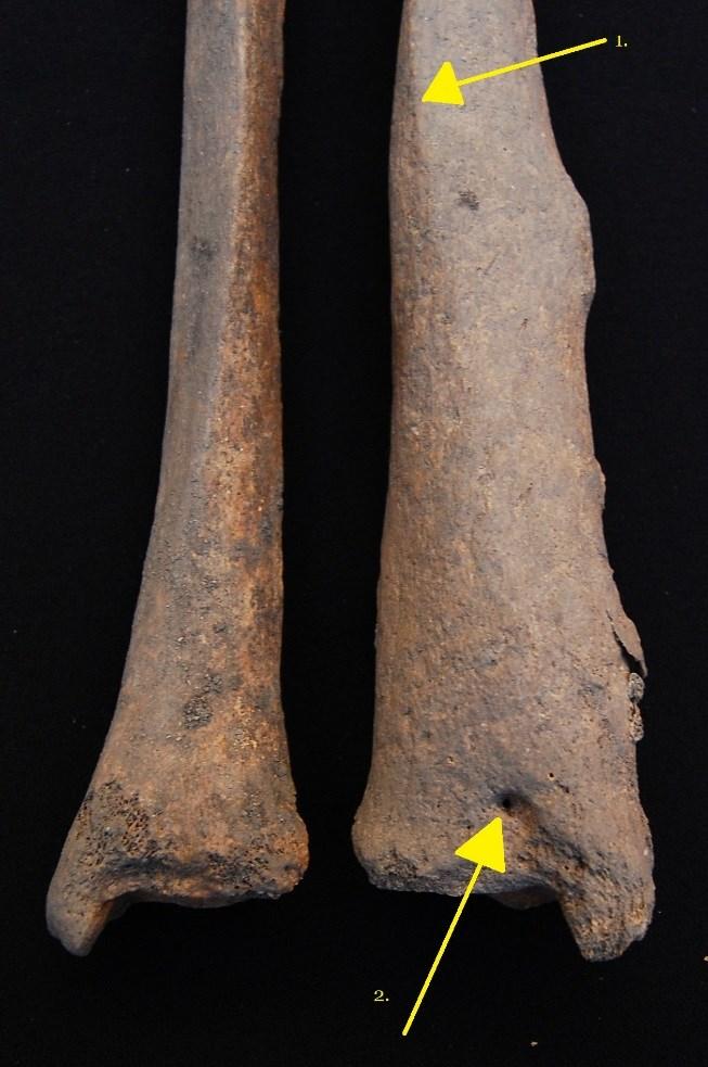 Figur 4. Individens skenben i ventral vy, med det friska, vänstra benet till vänster, och det högra med förändringen till höger.