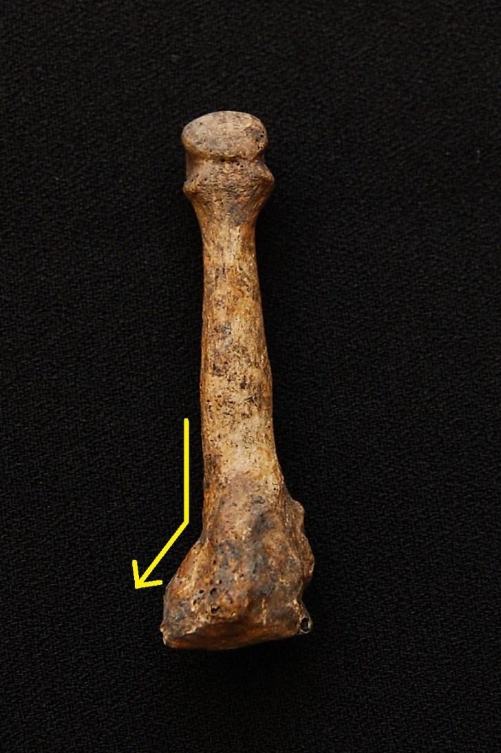 Figur 6. Mellanfotsbenet med frakturen i distala delen. Pilen markerar snedställningen. Dorsal vy. Foto: Malin Andersson Figur 7. Röntgenbild av mellanfotsbenet. Pilen markerar frakturlinje.