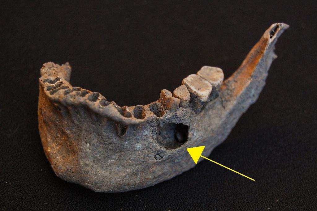 Figur 9. Individens underkäke. Pilen markerar hålrummet som har bildats av ett kariesangrepp på den första bakre kindtanden på vänster sida. Ventral vy. Foto: Malin Andersson 3.