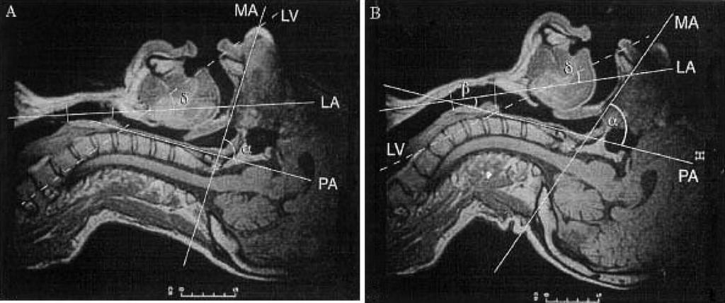 Svår luftväg Skador på mandibel och larynx Blödning från övre