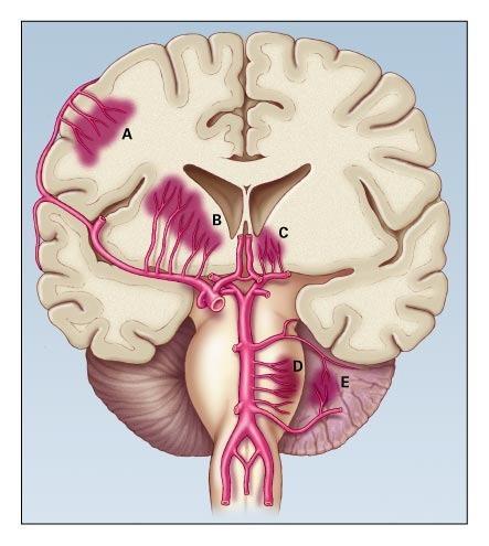 Hjärnblödning Ett blodkärl brister Vanliga lokalisationer för intracerebrala hematom