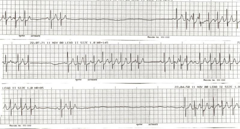 EKG i vila