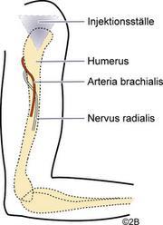 Den horisontella linjen som bildas utgör den tänkta uppochnervända triangeln med spetsen riktad neråt på armens lateral sida, i linje med axilla.