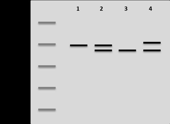Fråga 12 Cystisk fibros är en autosomalt recessiv sjukdom som kan orsakas av flera olika typer av mutationer i den så kallade CFTR-genen.
