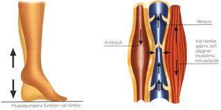 Principen med kompressionsbehandling Genom att anbringa ett tryck mot benet trycks befintligt ödem tillbaka venerna får hjälp att sluta tätt vadmuskeln