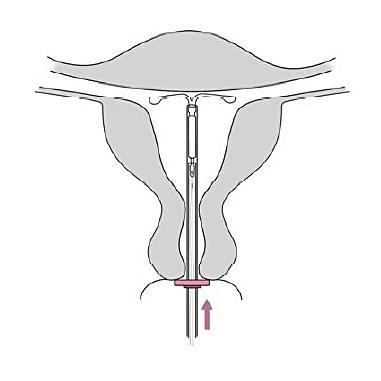 6. För försiktigt in insättningsröret mot fundus tills ringen /markören ligger mot portio /cervix. Jaydess bör nu vara vid fundus (bild 6). Bild 6 7.