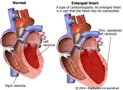 Klassifikation: New York Heart Association - NYHA I - inga symtom (ejection fraction <40%) II - andfåddhet vid uttalad fysisk aktivitet, gång i trappa III andfåddhet vid