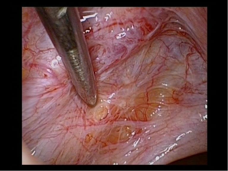 Kirurgisk behandling Laparoskopi med i första hand excision av ytliga eller djupa lesioner ger symtomlindring 6-12 månader Medicinsk