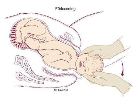 Det nyfödda barnet I samband med att det nyfödda barnet börjar skrika fylls lungorna med luft och då behövs inte moderkakan längre för att tillföra syre och transportera bort koldioxid.